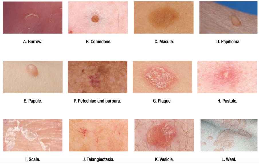 Skin Lesions: Know Everything- Cause, Types, And Symptoms